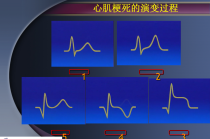 心律失常识别 - 心律失常识别及处理