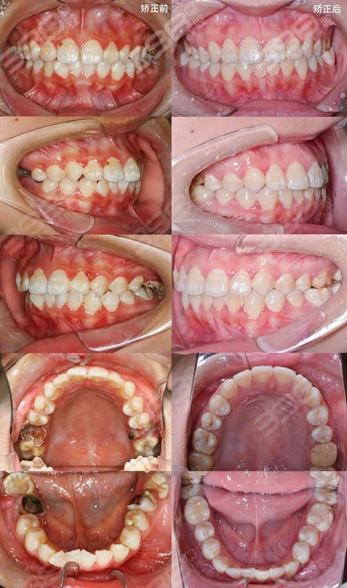 牙齿正畸常识（牙齿正畸有几种方式）  第7张