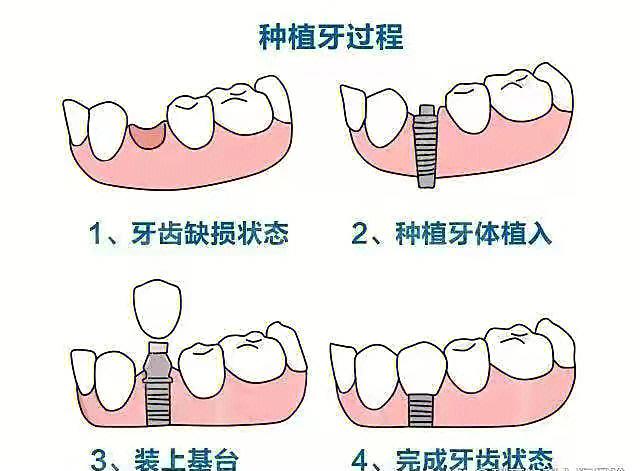 种植牙常识种植牙介绍 - 种植牙种植条件  第1张
