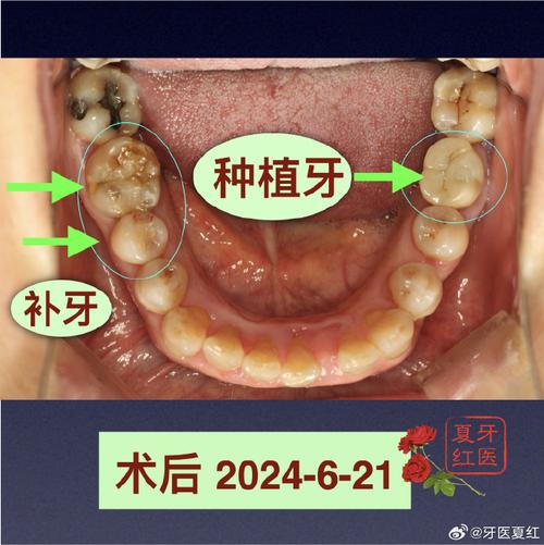 种植牙常识种植牙介绍 - 种植牙种植条件  第5张