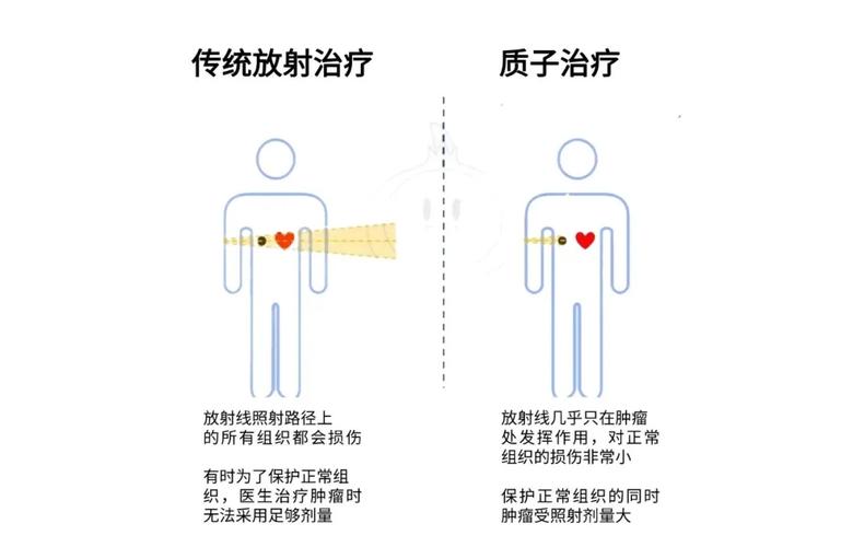 放疗常识是什么意思，放疗的专业术语  第5张